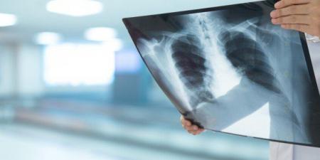 تجربة سريرية تكشف دواءً جديداً قد يُحدث تحولاً في علاج السل المقاوم للأدوية - تواصل نيوز