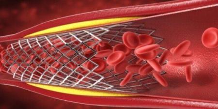 انسداد الشرايين.. الأعراض والأسباب وطرق الوقاية - تواصل نيوز