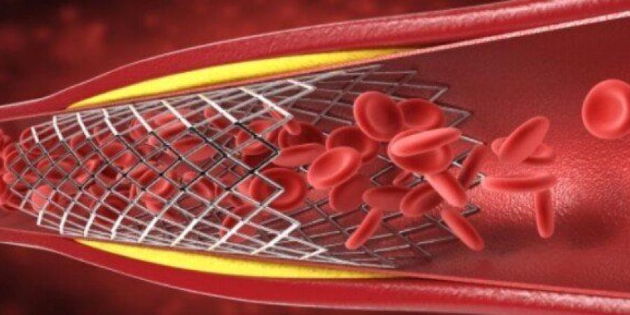 انسداد الشرايين.. الأعراض والأسباب وطرق الوقاية - تواصل نيوز