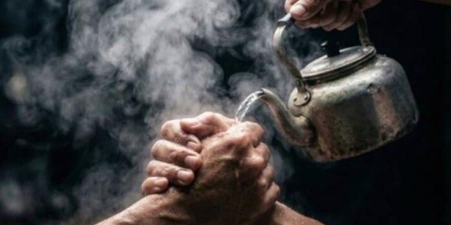 خاص| مسئول يكشف تداعيات «تريند الشاي المغلي»: إصابات وتشوهات خطيرة - تواصل نيوز