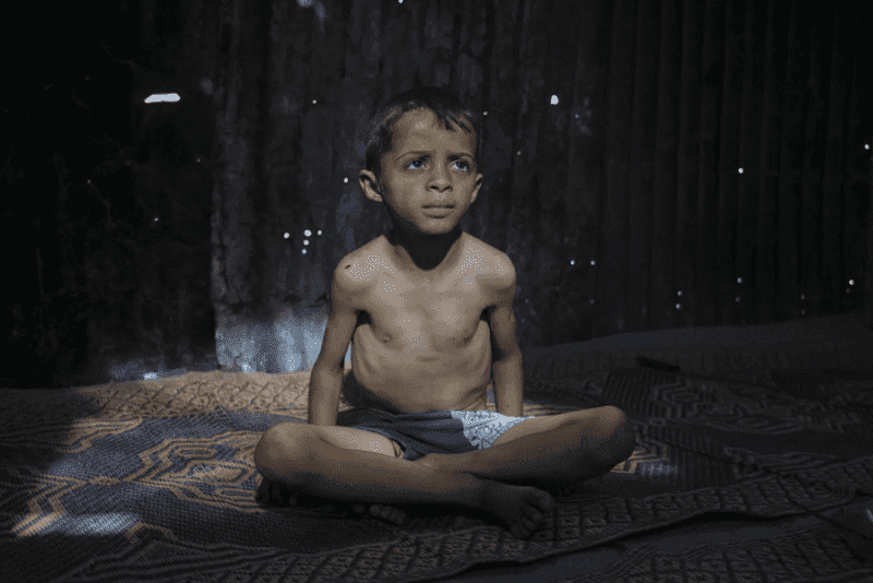 أربع حالات وفيات في غزة خلال 24 ساعة بسبب المجاعة وسوء التغذية